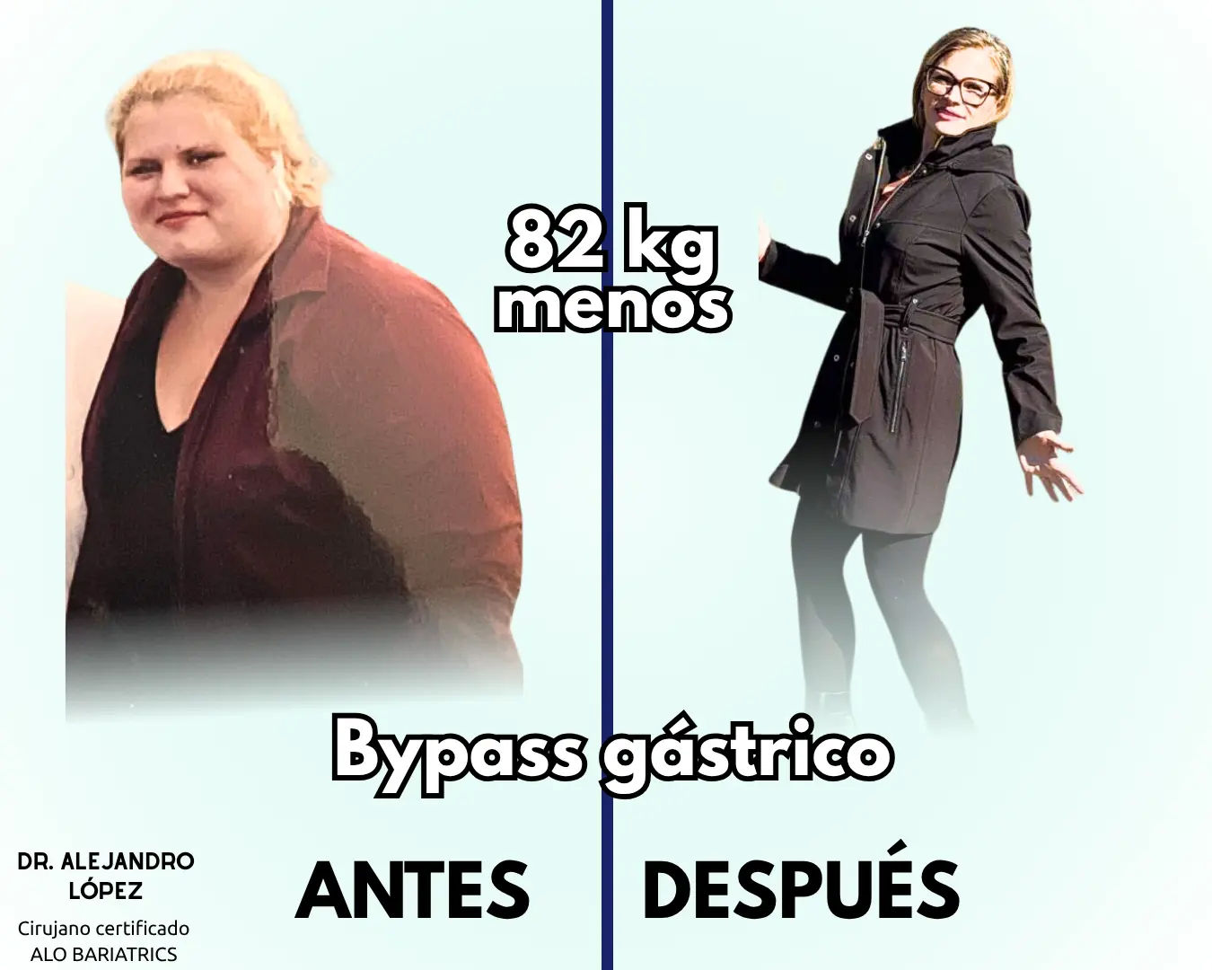 Antes y despues de Bypass gástrico con el Dr. Alejandro López