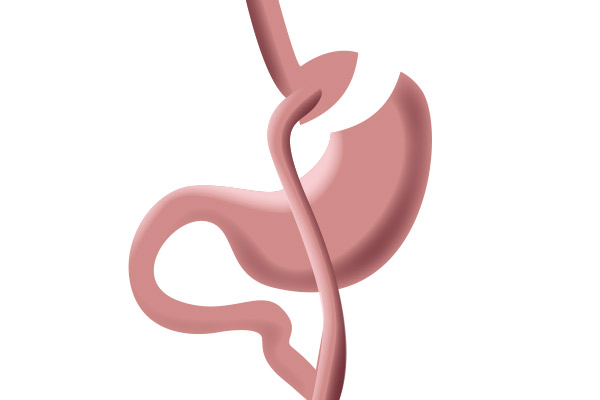 Qué es el bypass gástrico - cirugía bariátrica