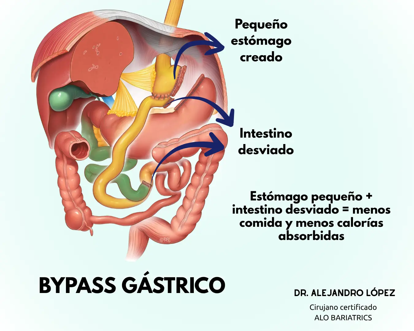 Bypass gástrico - Cirugía bariátrica en Guadalajara