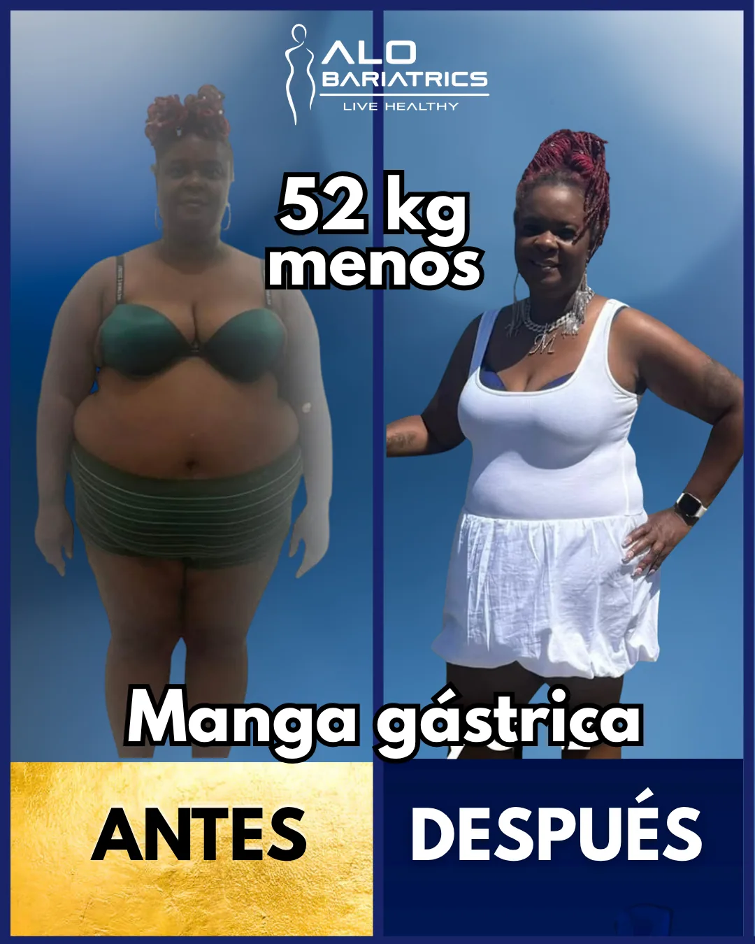 Bariatric surgery before and after — patient 1