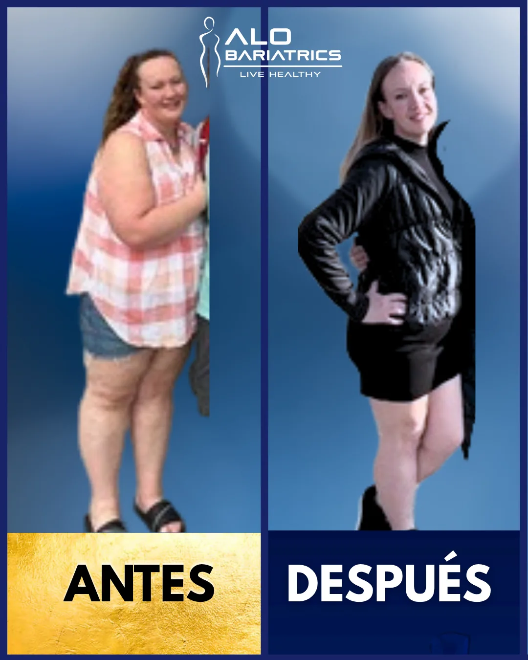 Bariatric surgery before and after — patient 10