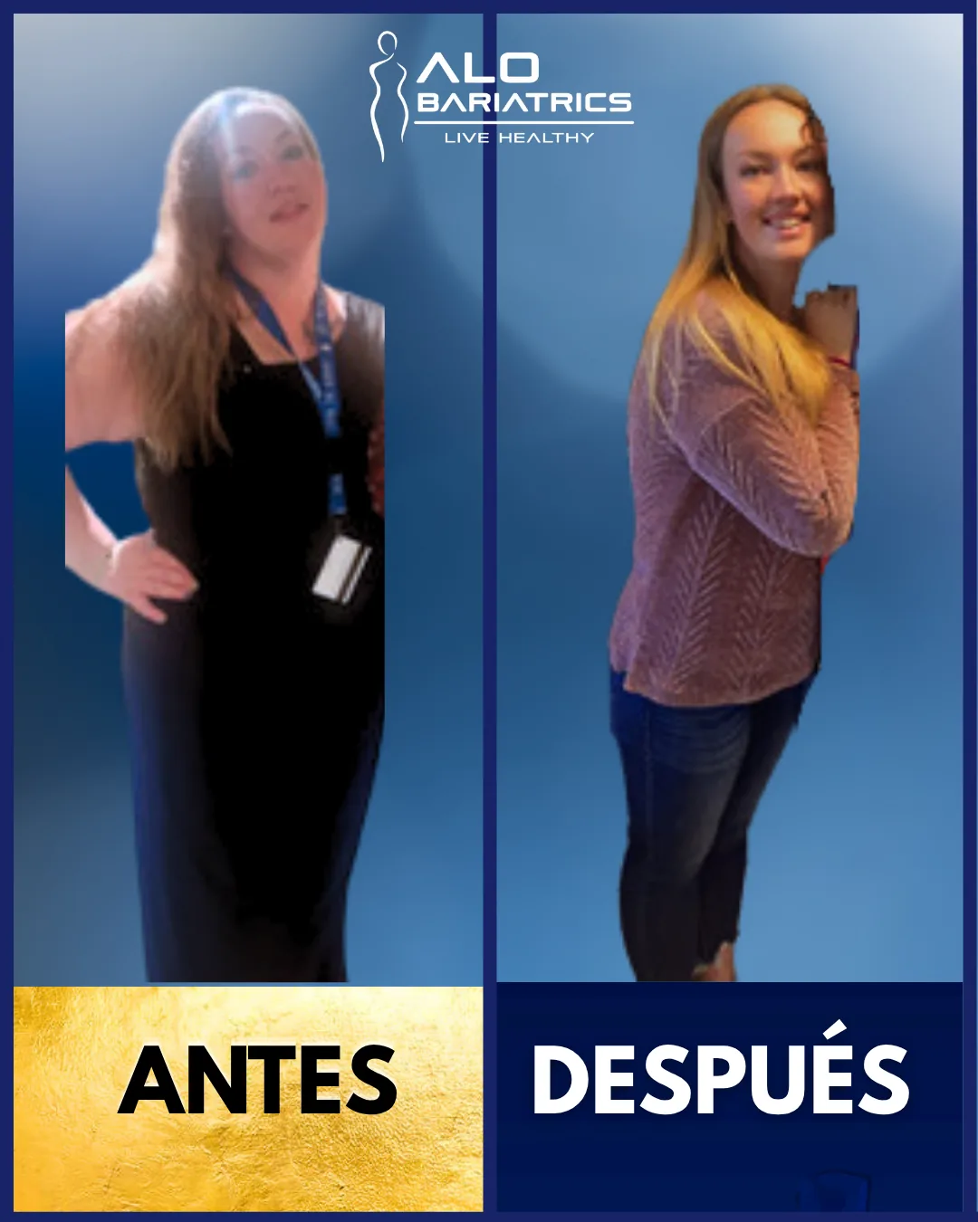Bariatric surgery before and after — patient 11