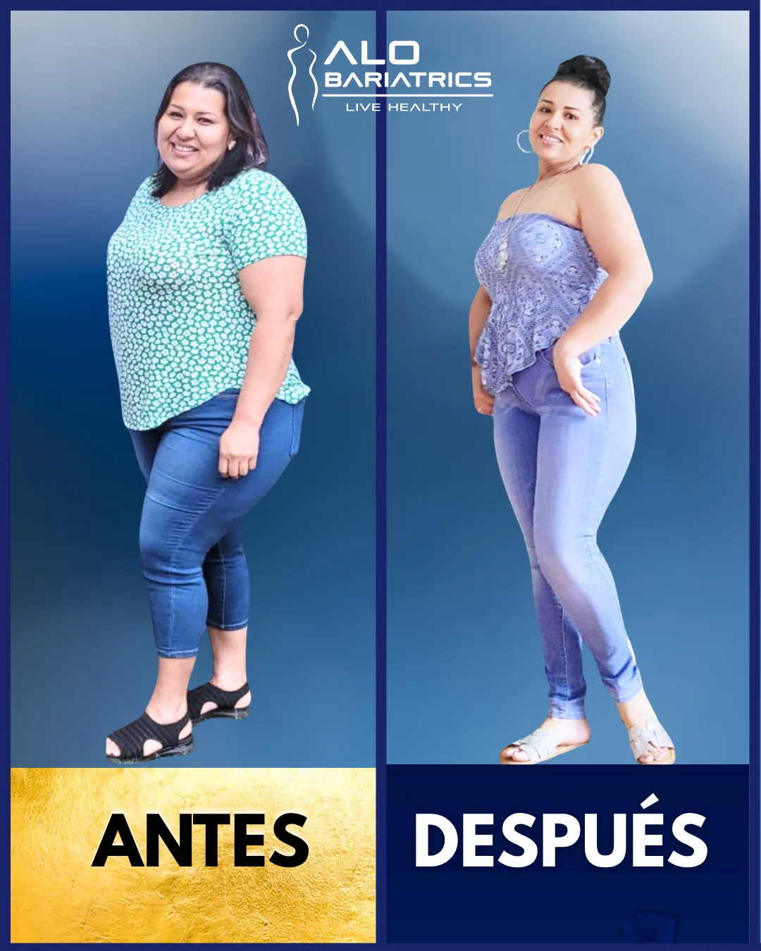 Bariatric surgery before and after — patient 12