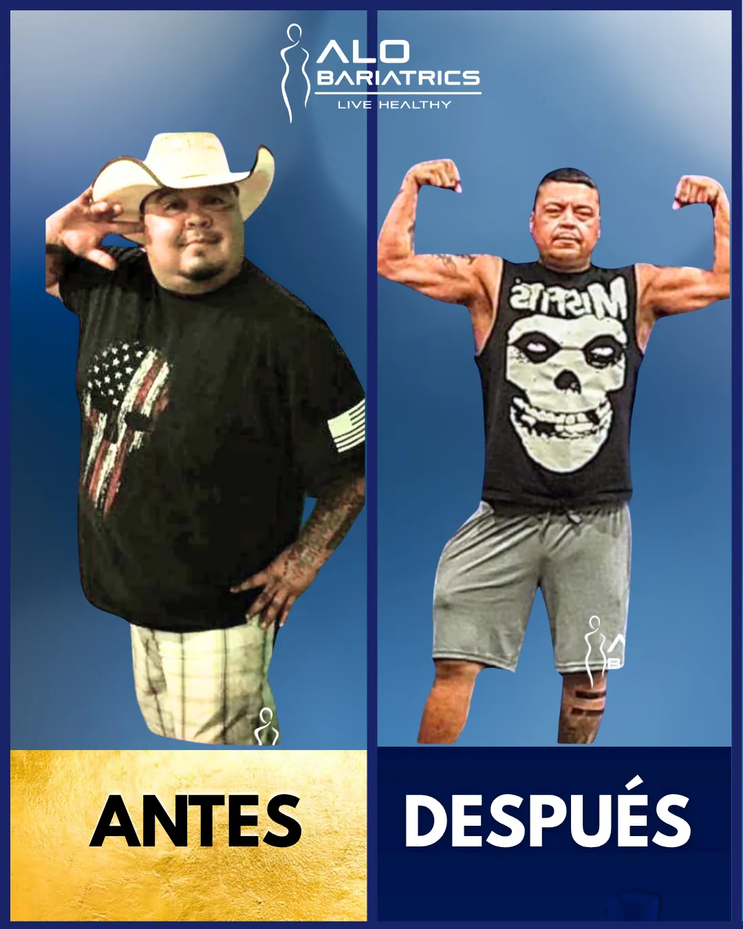 Bariatric surgery before and after — patient 13