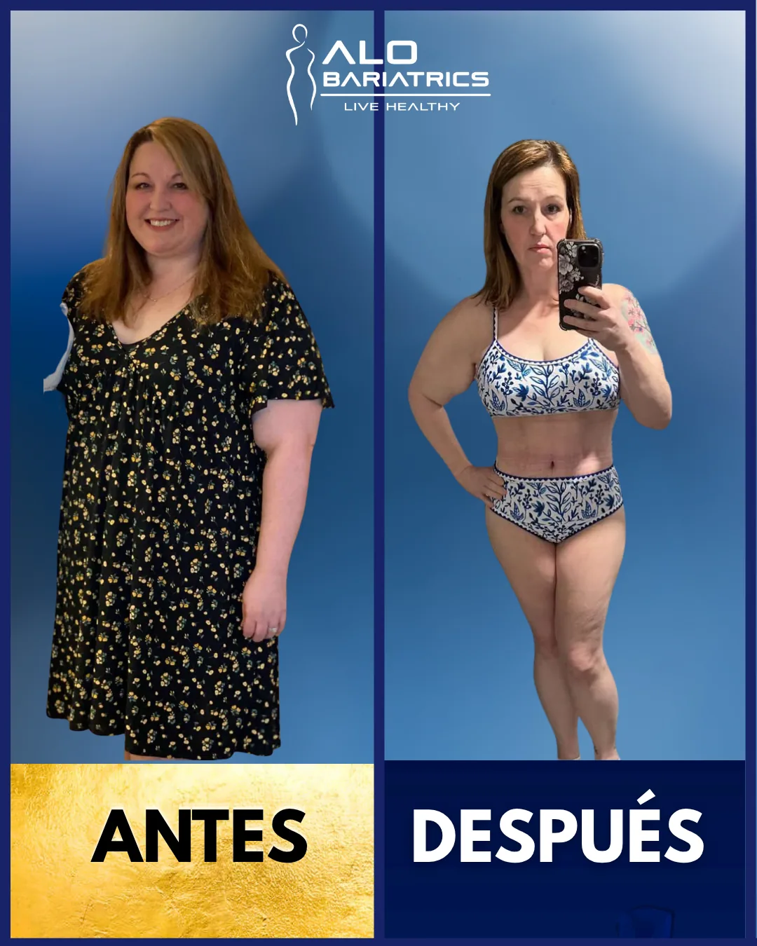 Bariatric surgery before and after — patient 14
