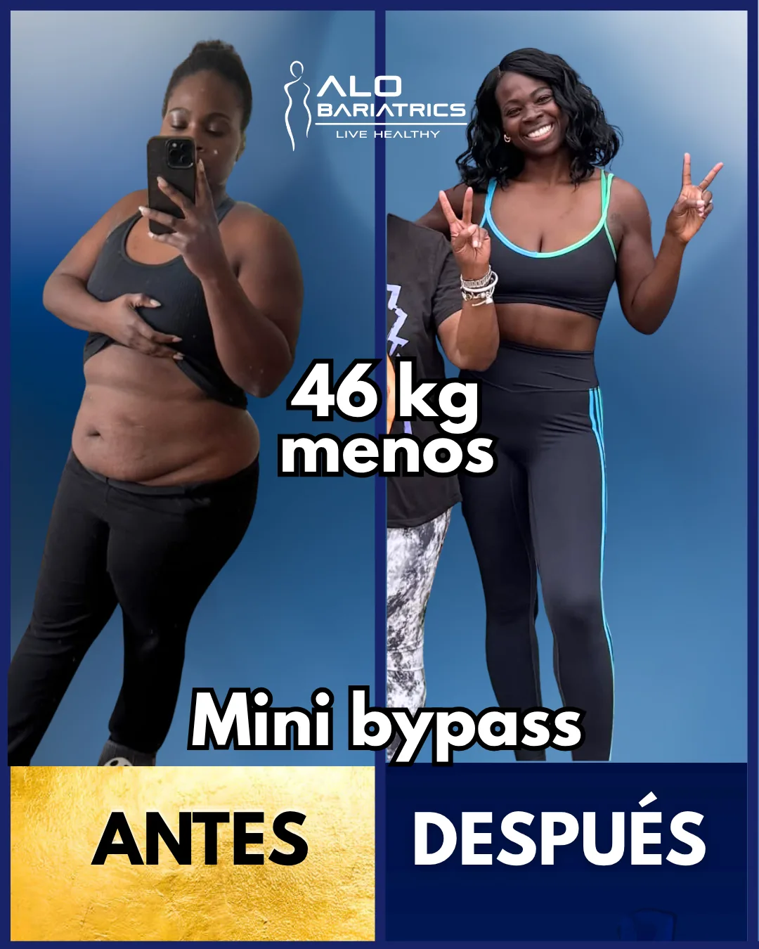 Bariatric surgery before and after — patient 16