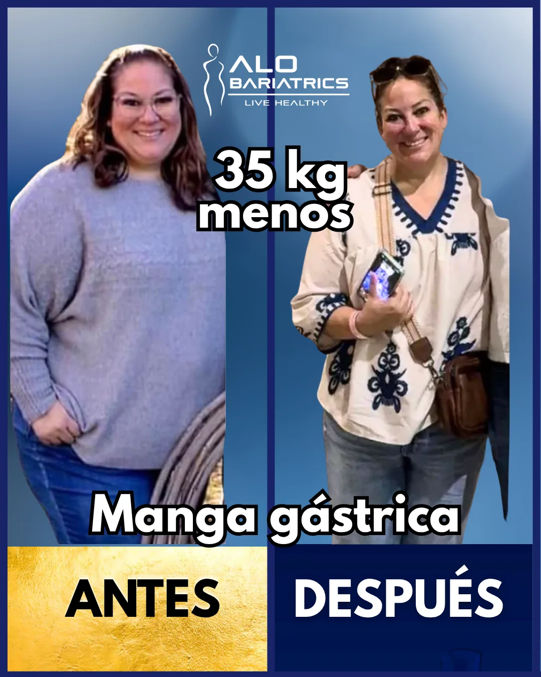Bariatric surgery before and after — patient 17