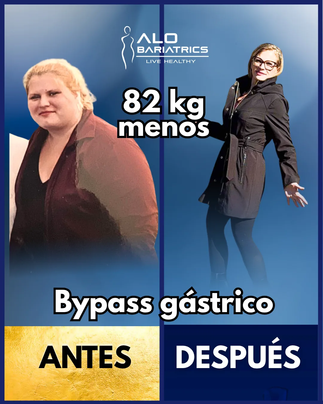Bariatric surgery before and after — patient 18