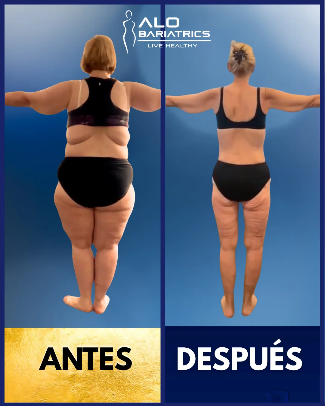 Bariatric surgery before and after — patient 19