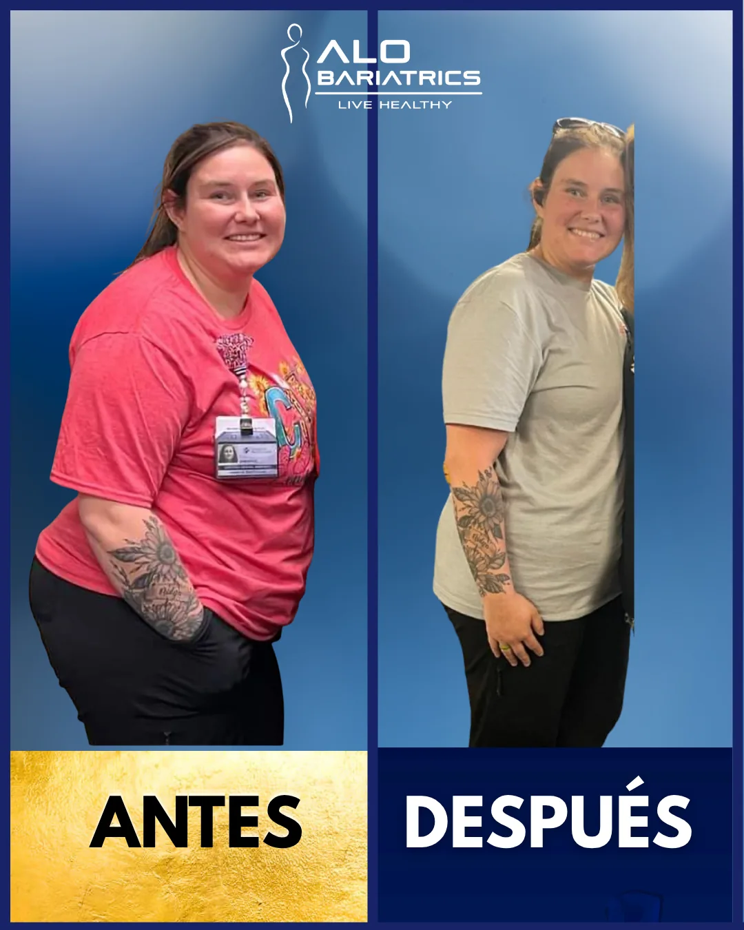Bariatric surgery before and after — patient 20