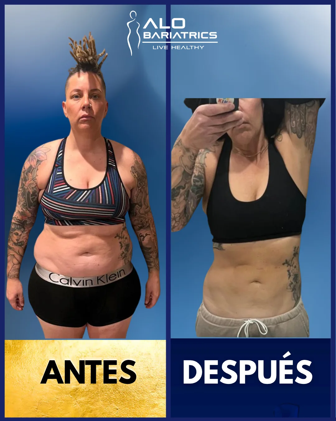 Bariatric surgery before and after — patient 21