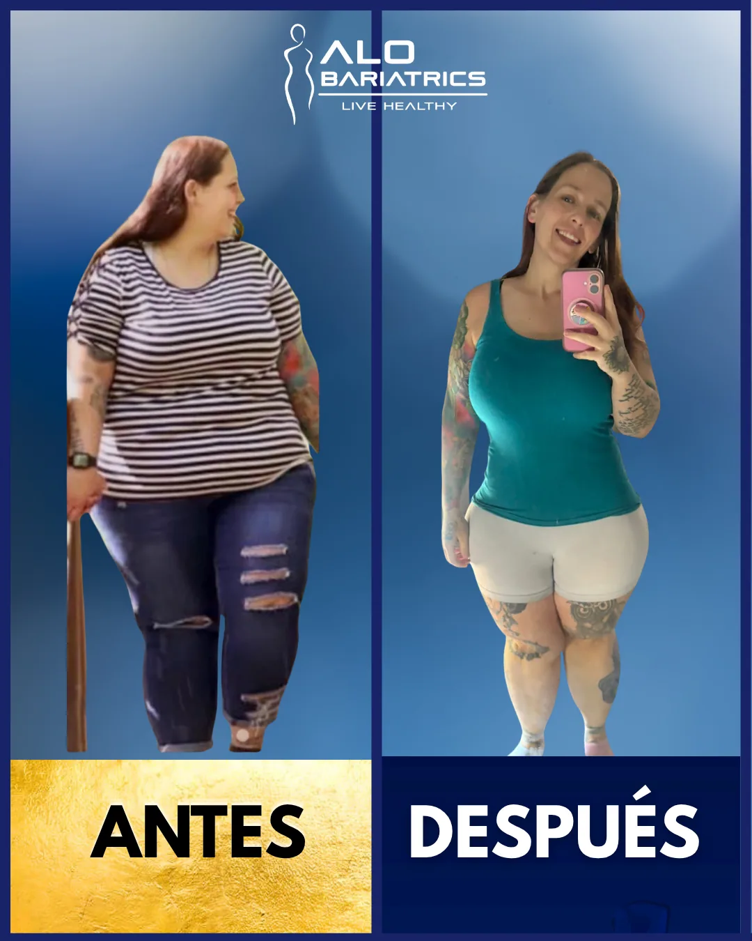 Bariatric surgery before and after — patient 22