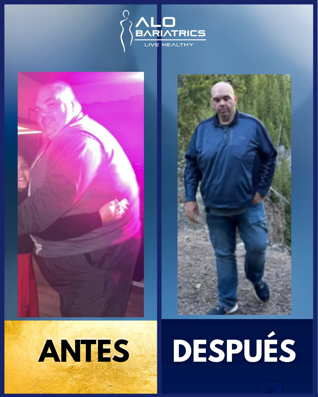 Bariatric surgery before and after — patient 23