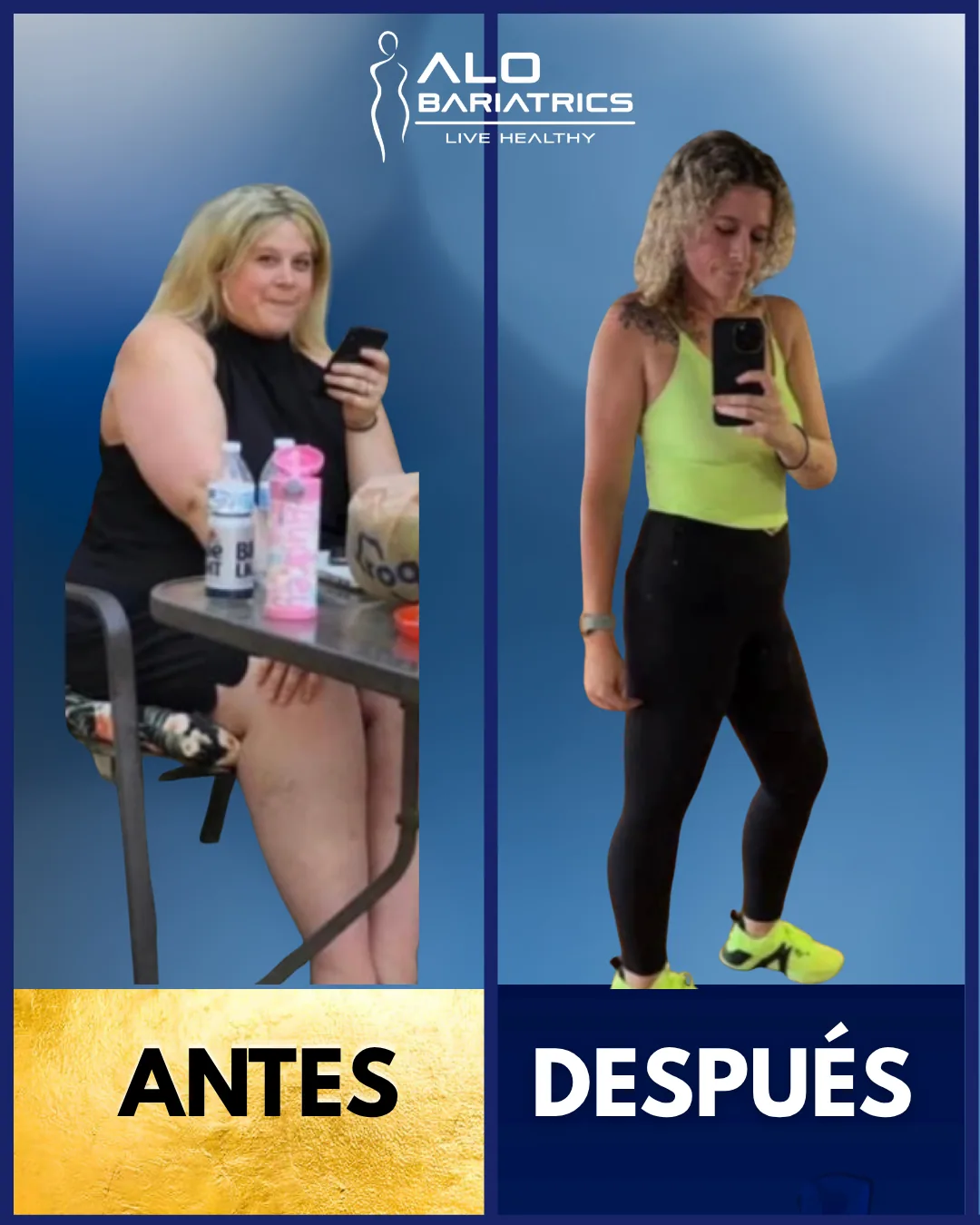 Bariatric surgery before and after — patient 24