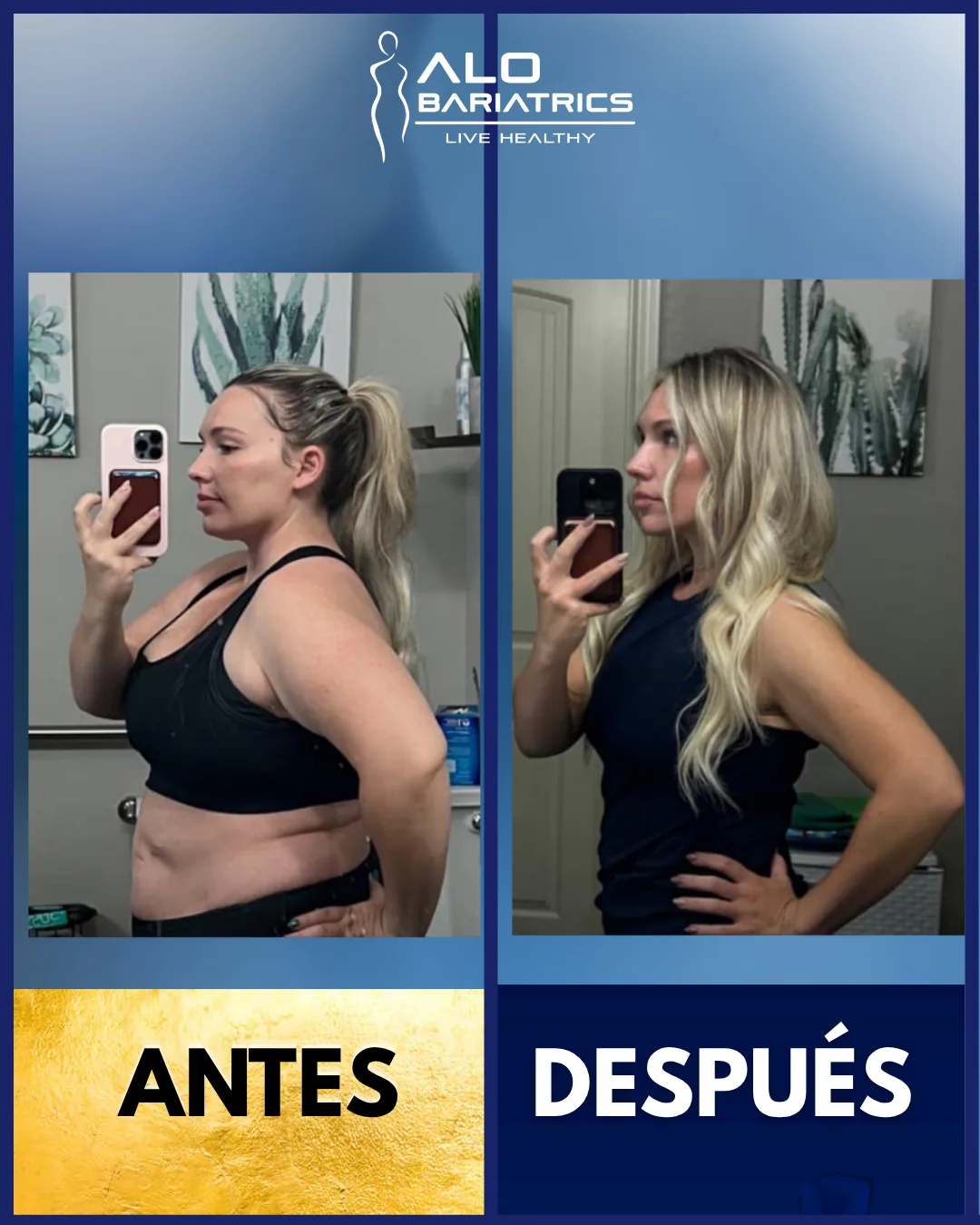 Bariatric surgery before and after — patient 25