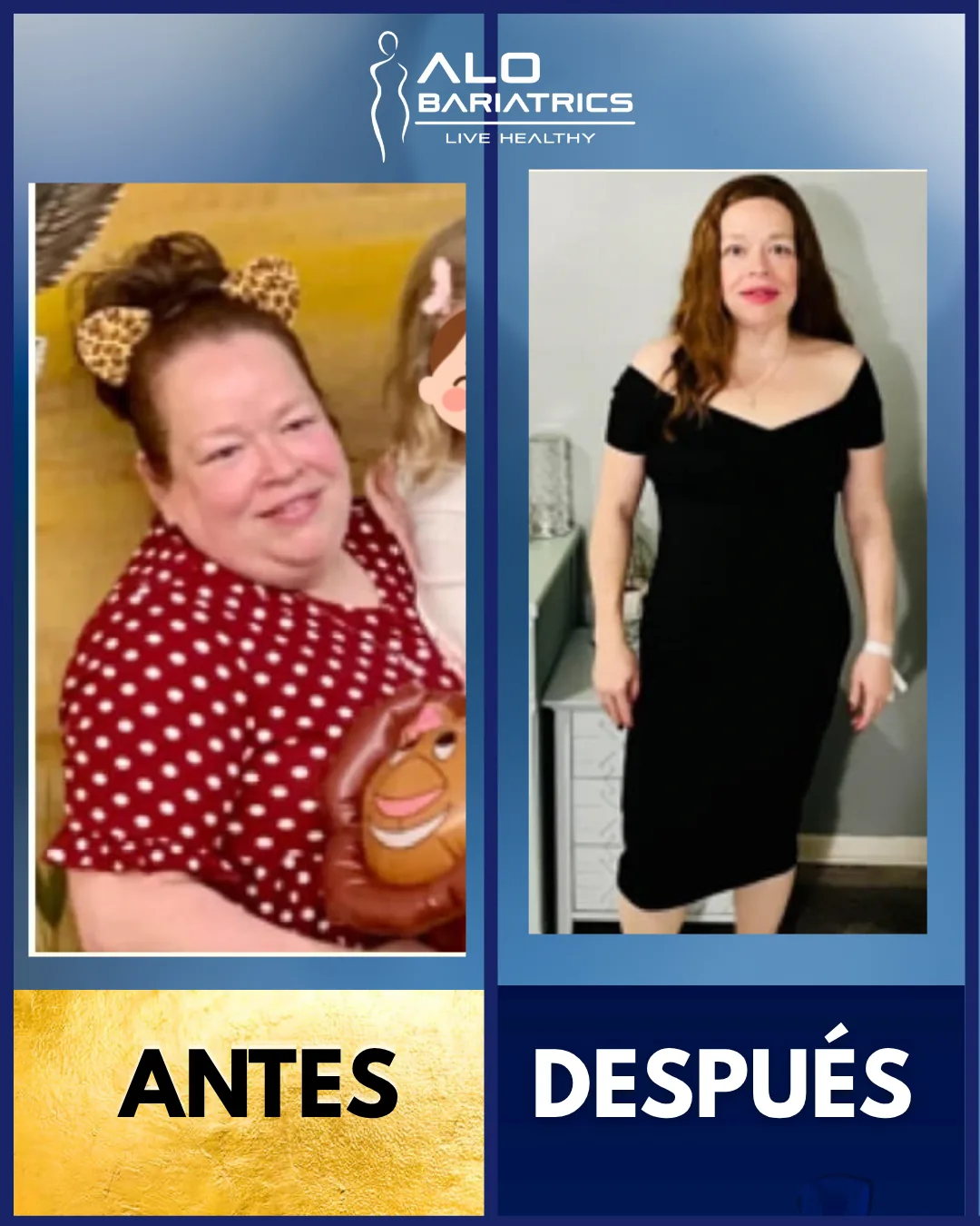 Bariatric surgery before and after — patient 26