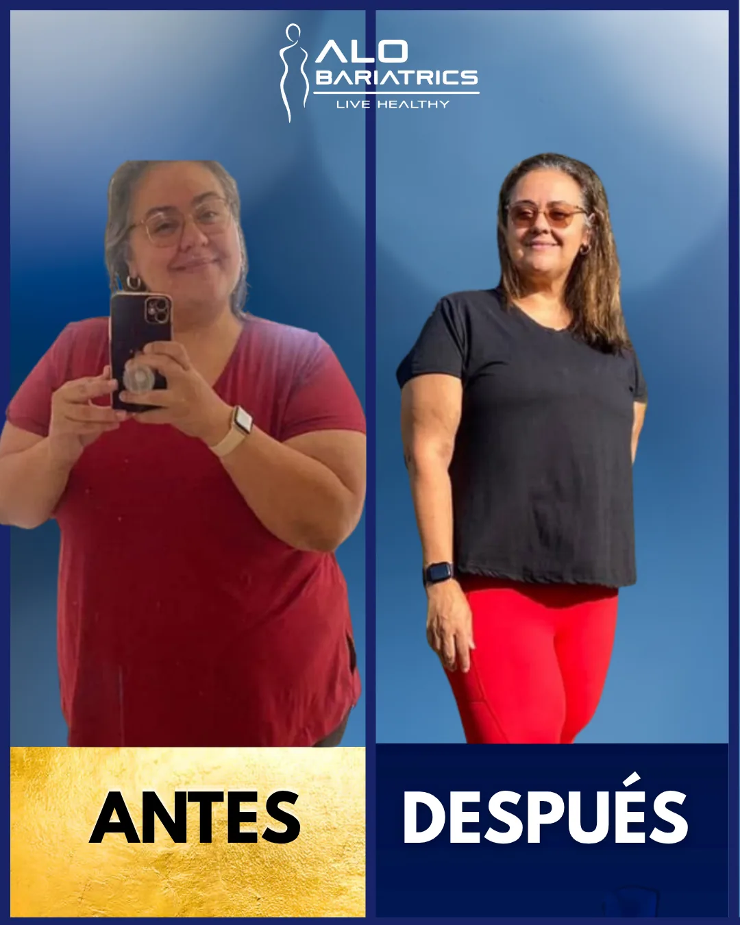 Bariatric surgery before and after — patient 27