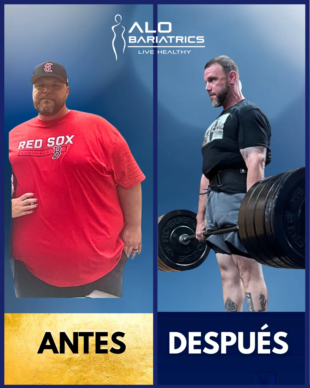 Bariatric surgery before and after — patient 28