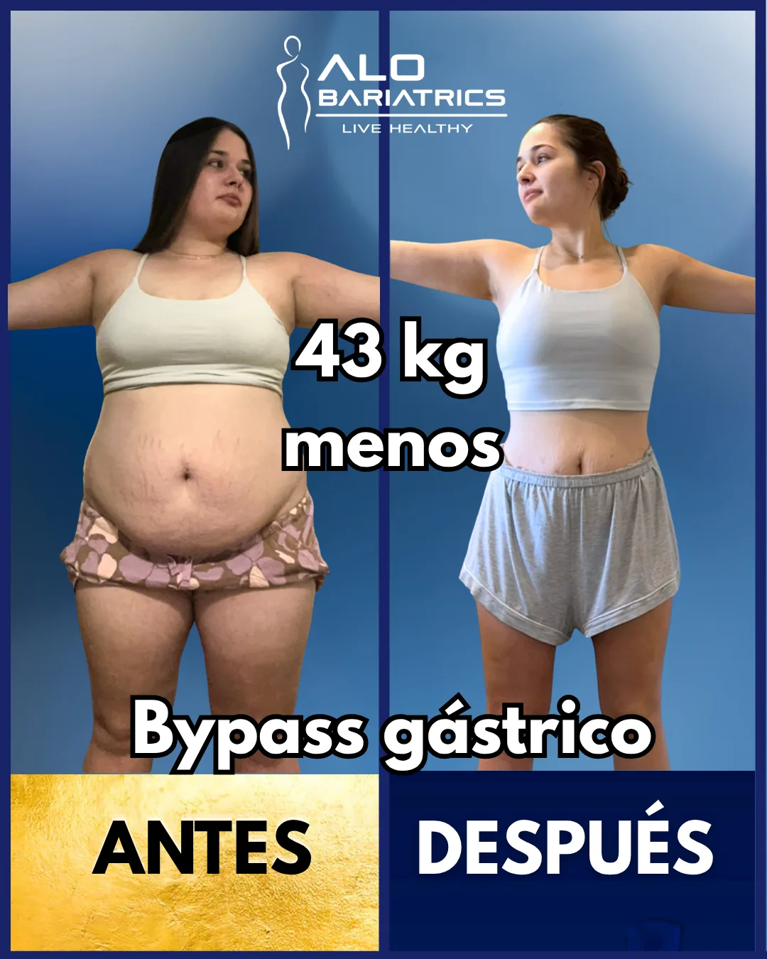 Bariatric surgery before and after — patient 29