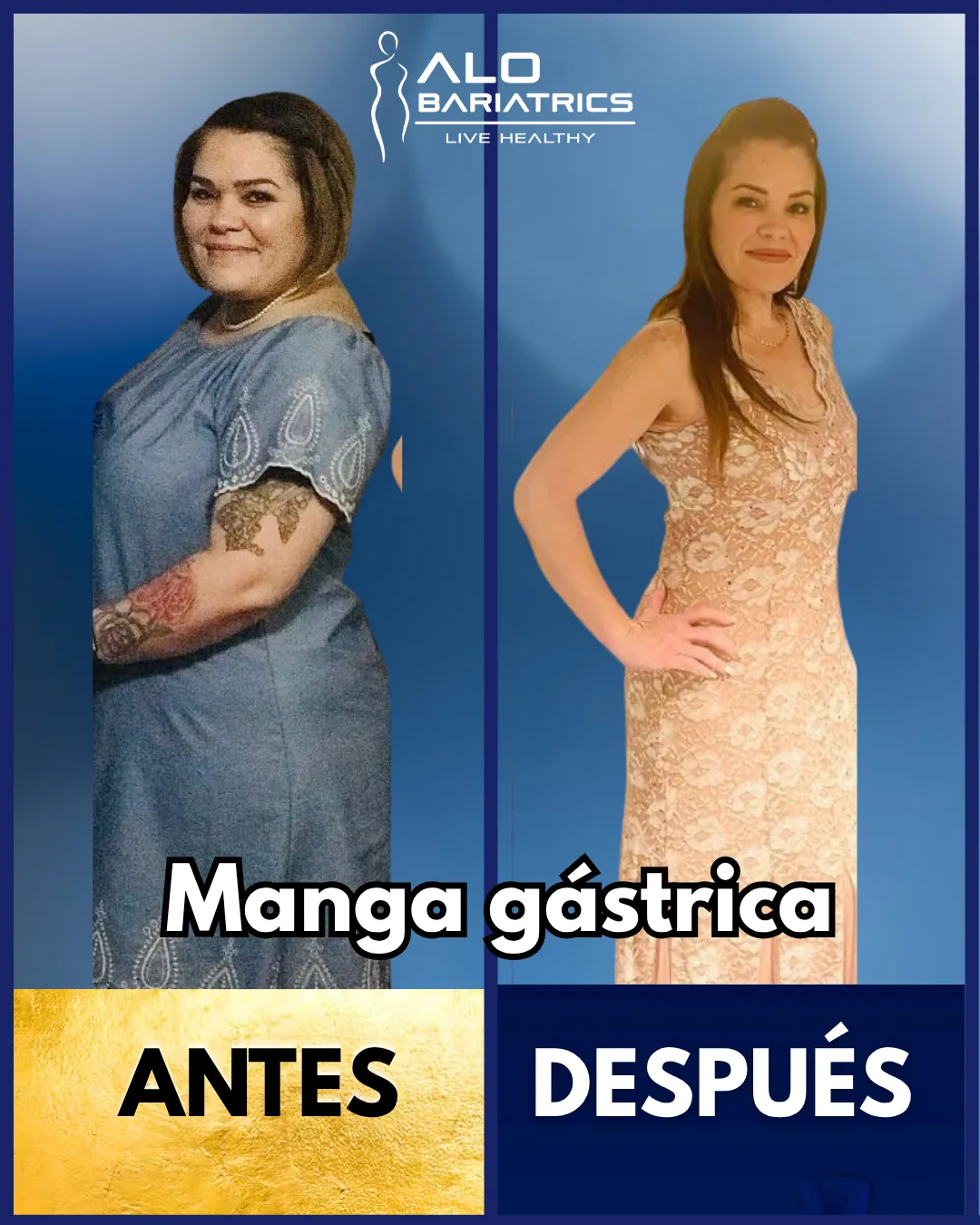 Bariatric surgery before and after — patient 3