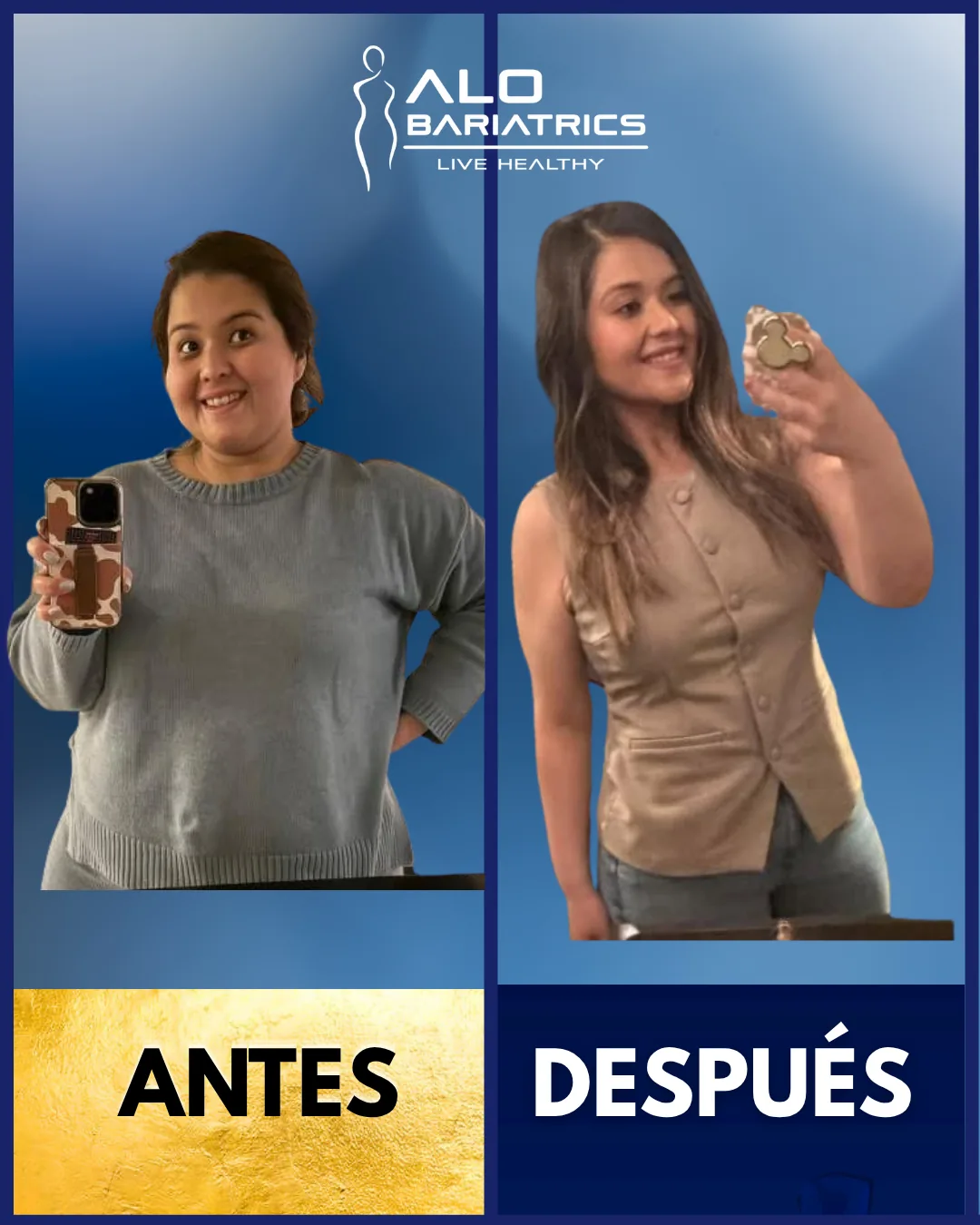 Bariatric surgery before and after — patient 30