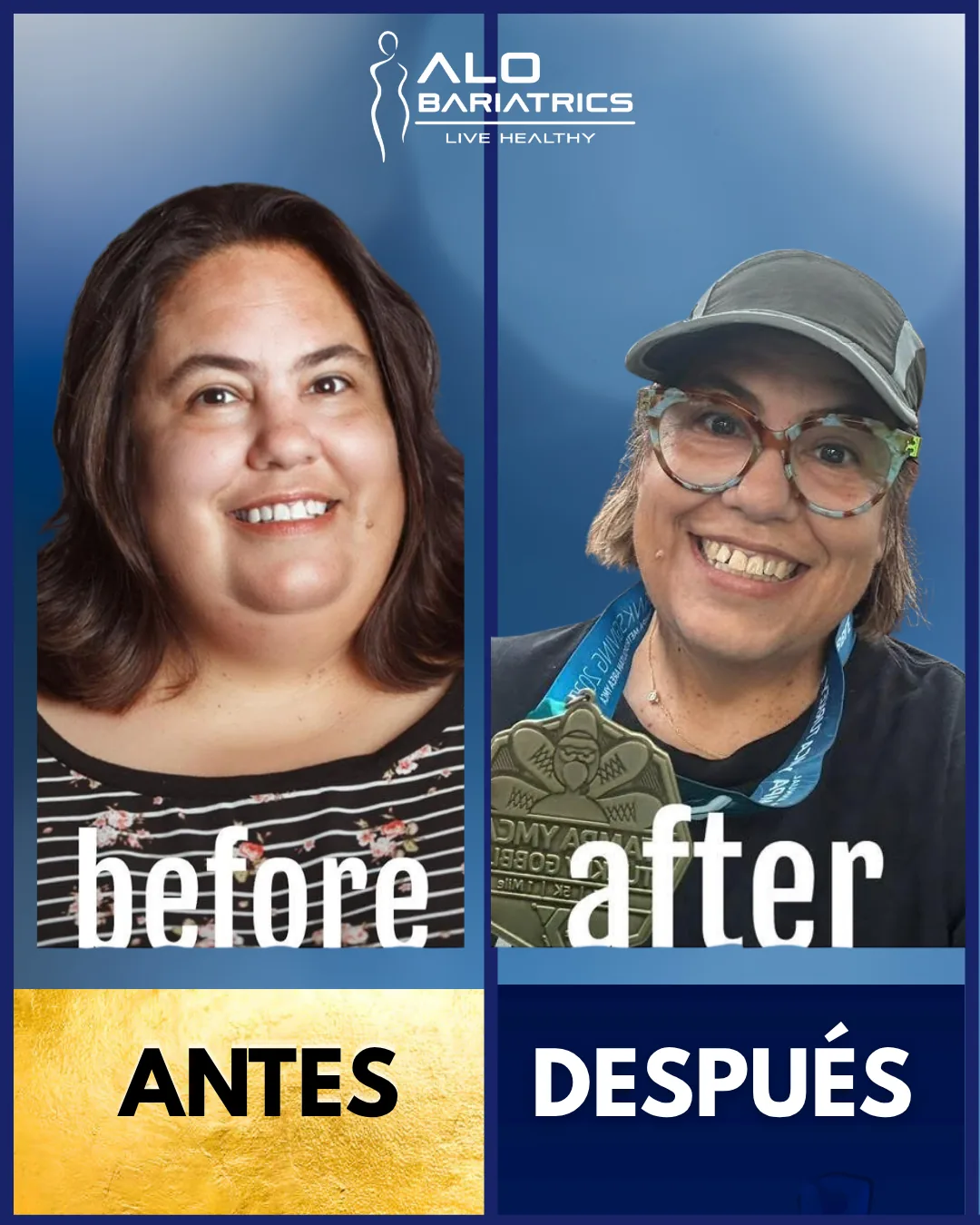 Bariatric surgery before and after — patient 31
