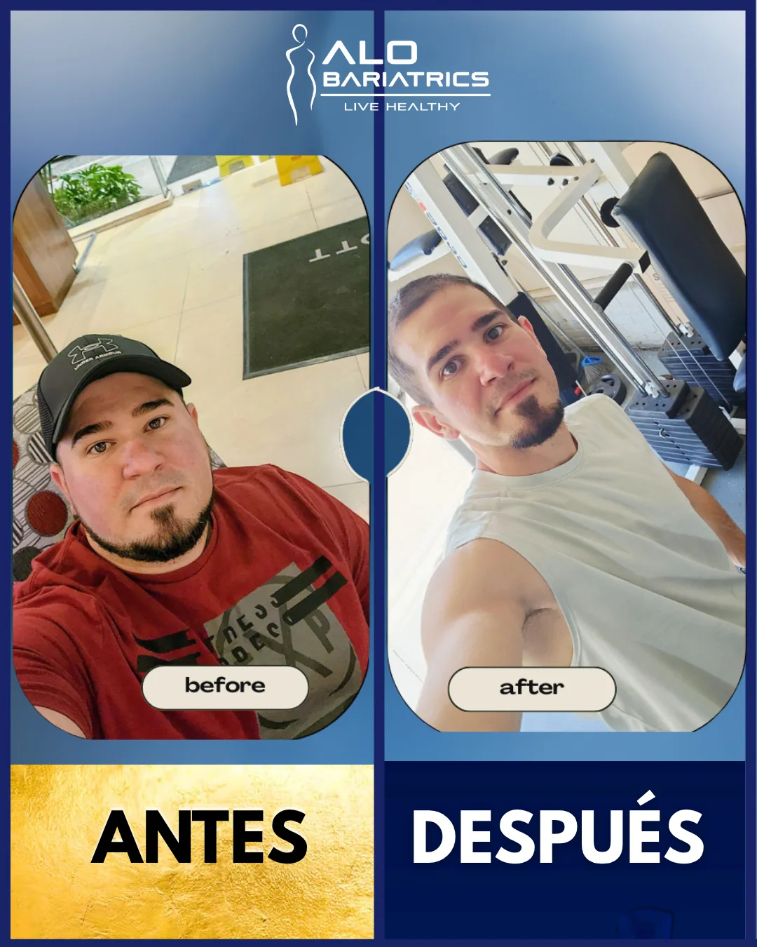 Bariatric surgery before and after — patient 32