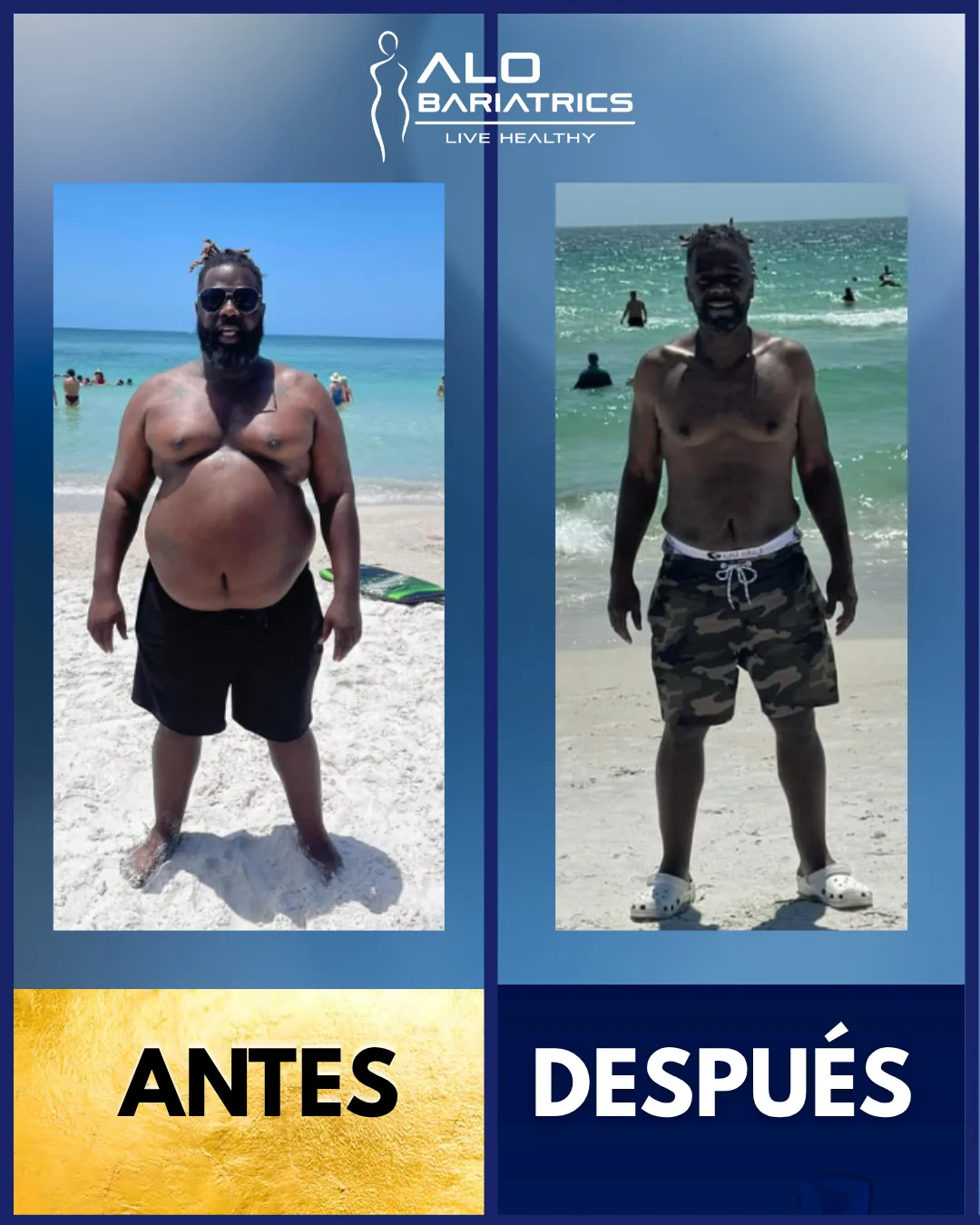 Bariatric surgery before and after — patient 33