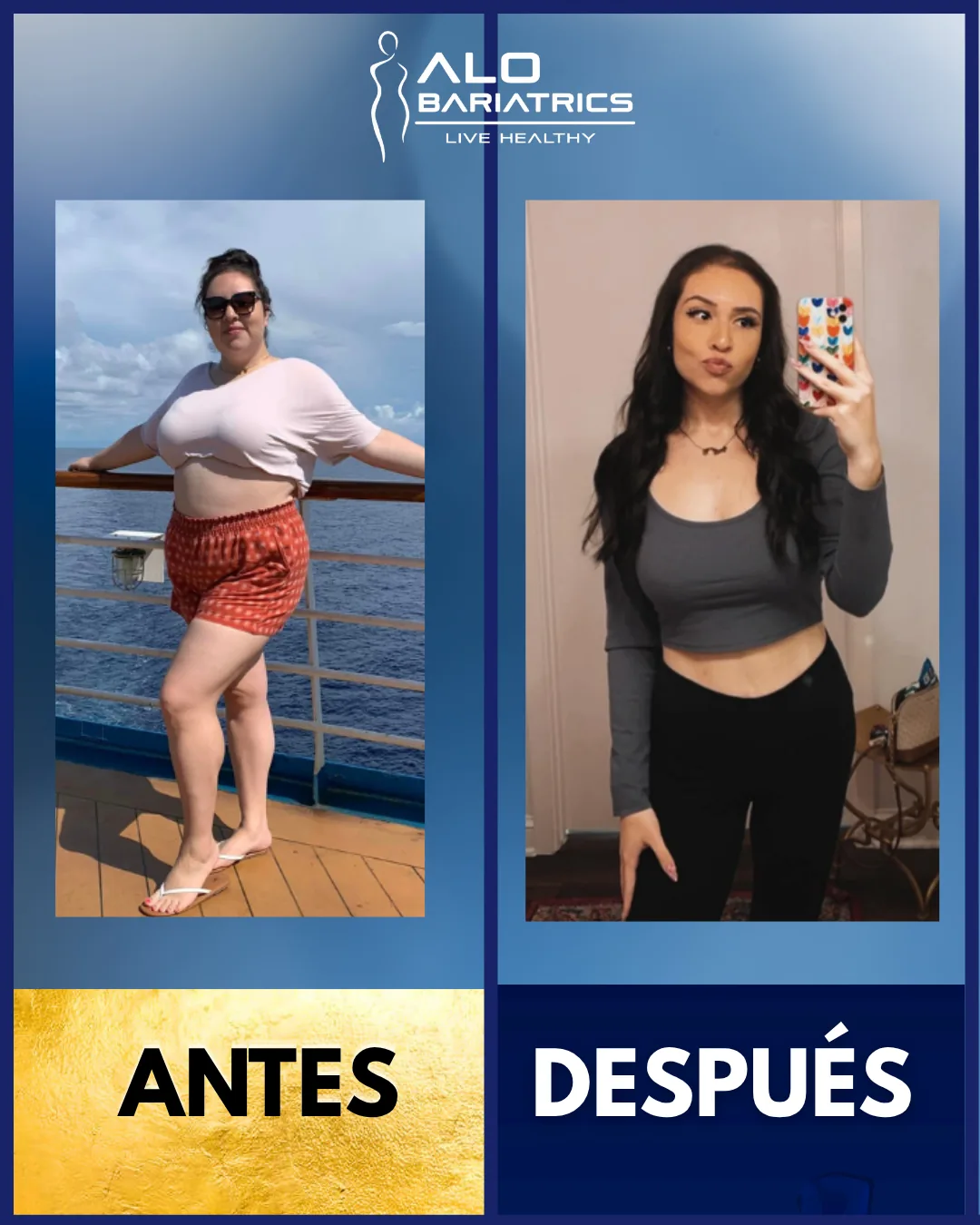 Bariatric surgery before and after — patient 34