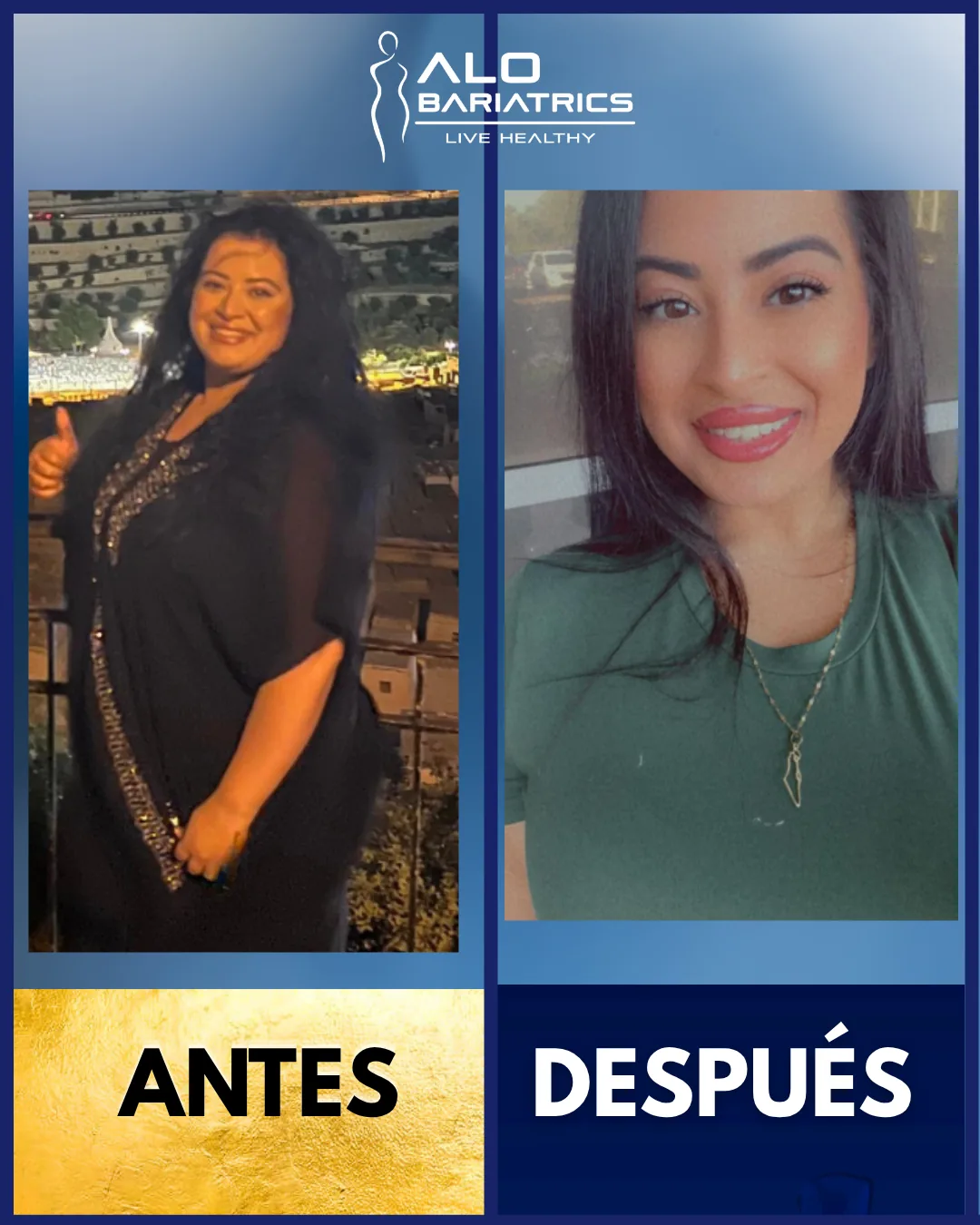 Bariatric surgery before and after — patient 35