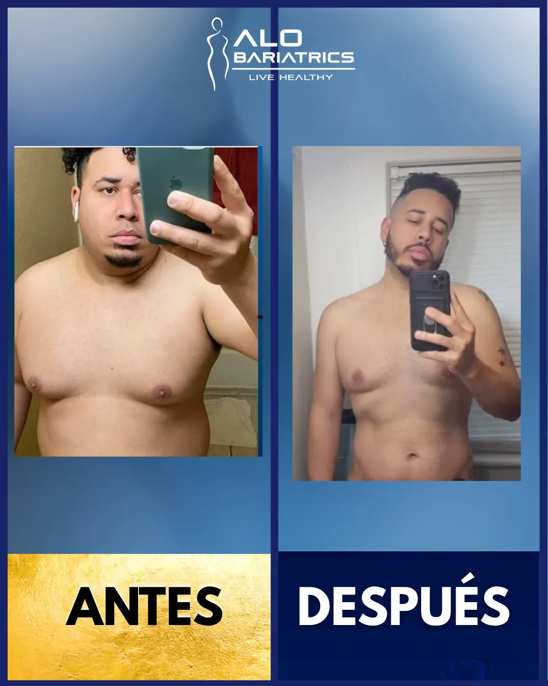 Bariatric surgery before and after — patient 37
