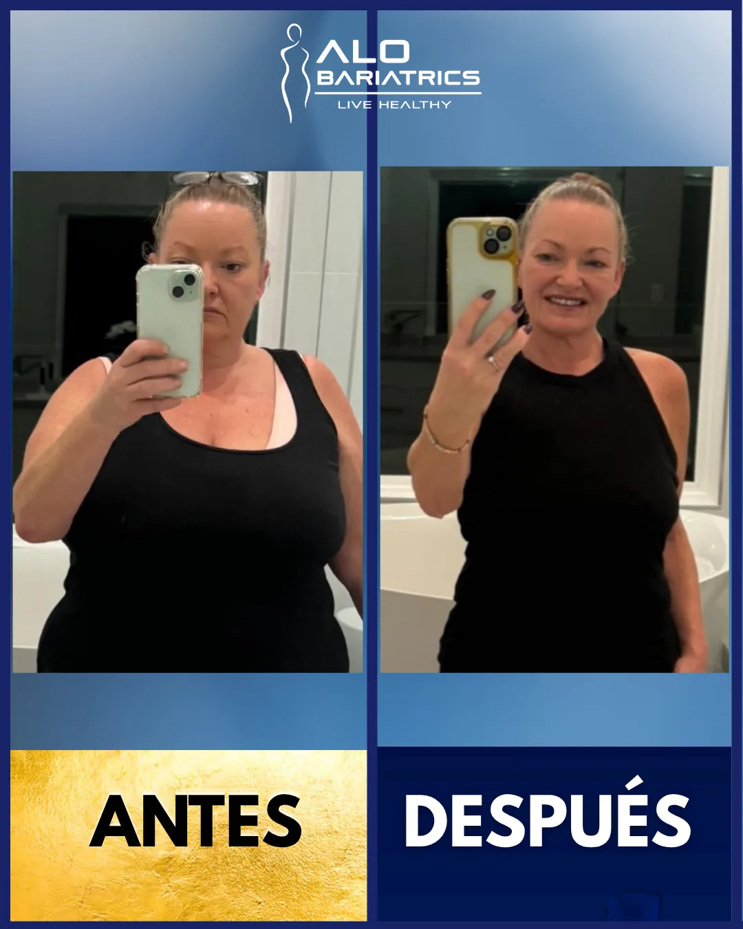 Bariatric surgery before and after — patient 38