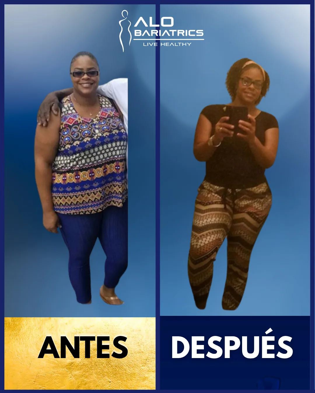 Bariatric surgery before and after — patient 39