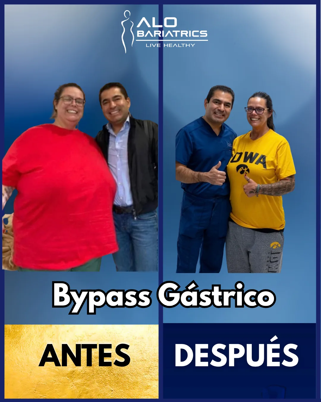 Bariatric surgery before and after — patient 4
