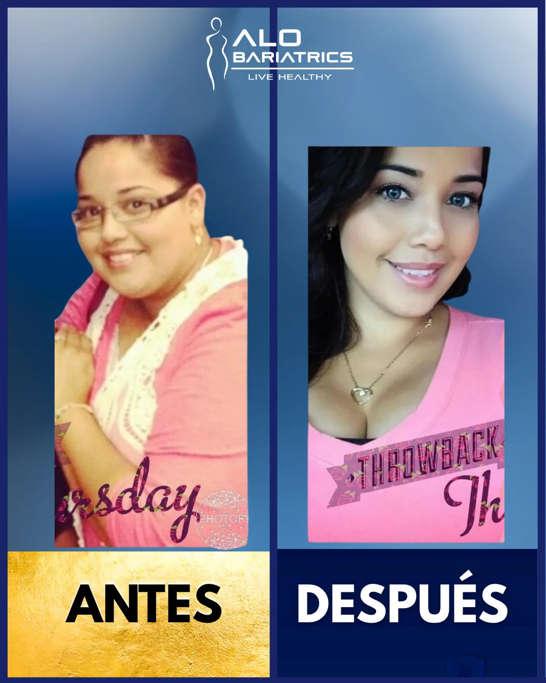 Bariatric surgery before and after — patient 41