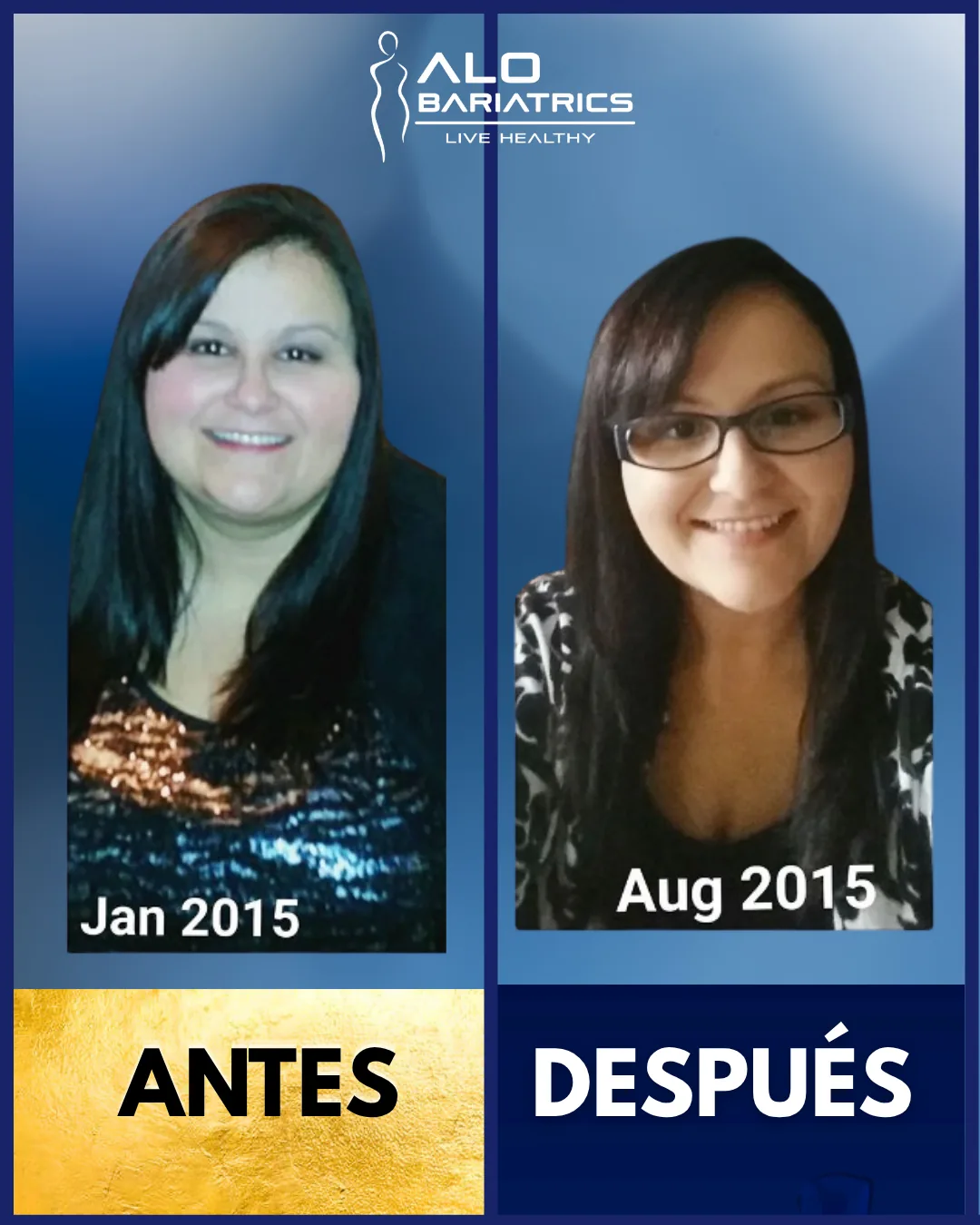 Bariatric surgery before and after — patient 42
