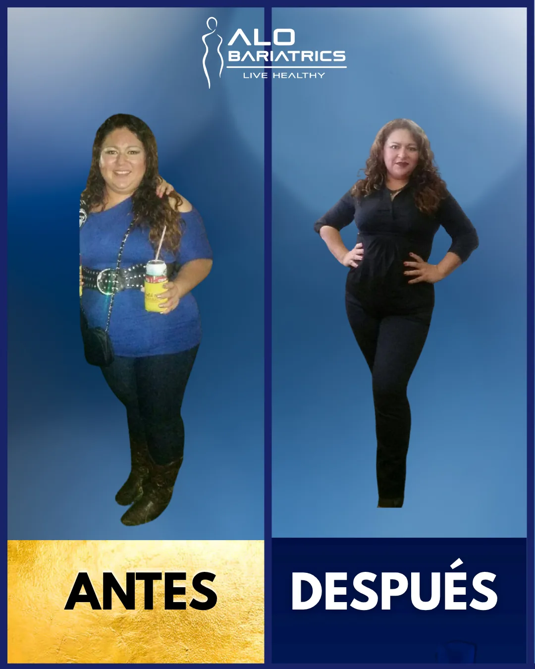 Bariatric surgery before and after — patient 43