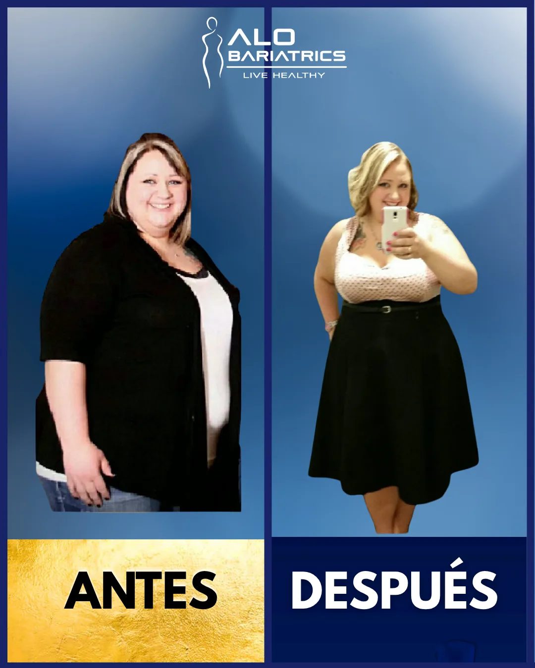 Bariatric surgery before and after — patient 44