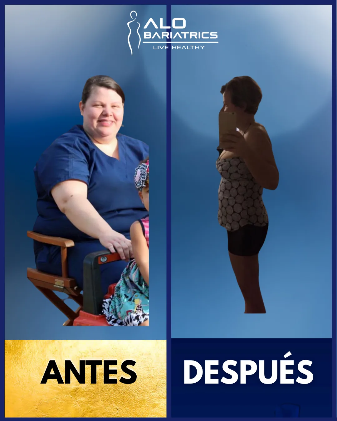Bariatric surgery before and after — patient 45