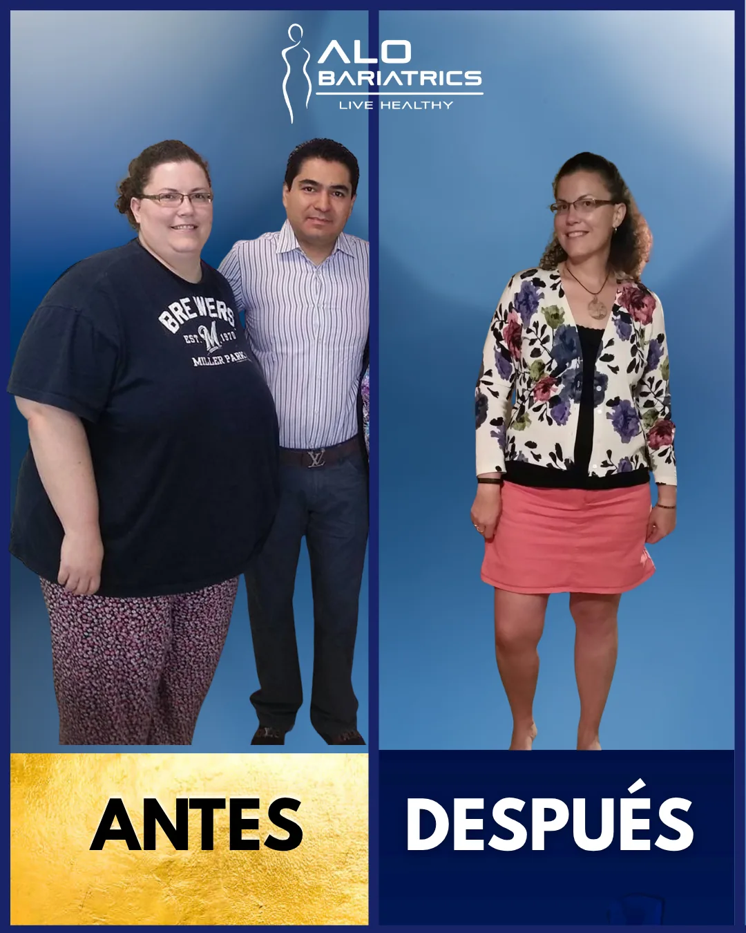 Bariatric surgery before and after — patient 46