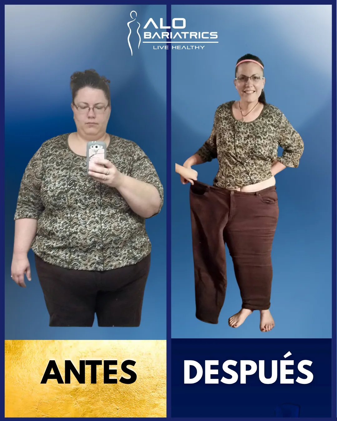 Bariatric surgery before and after — patient 47