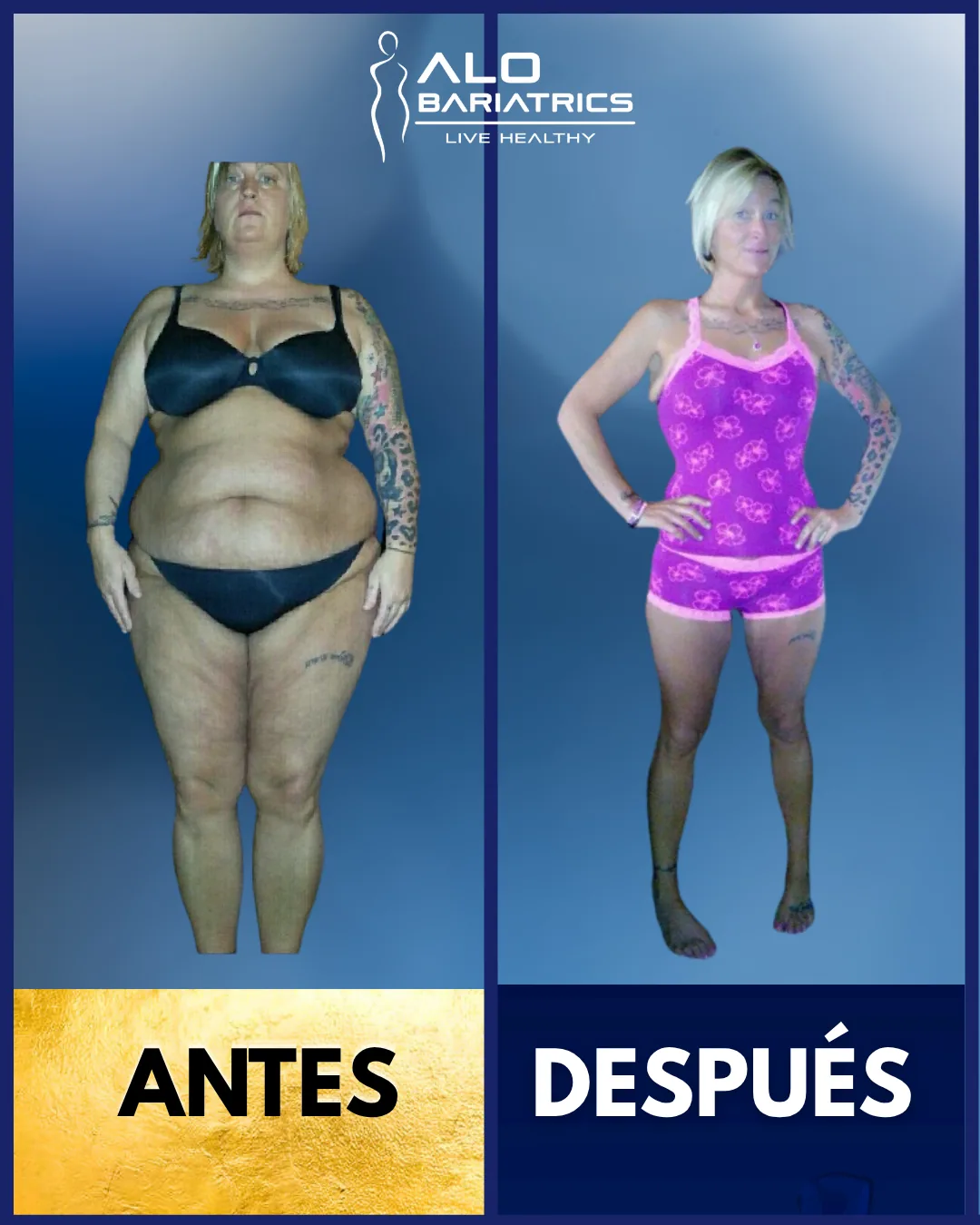 Bariatric surgery before and after — patient 48
