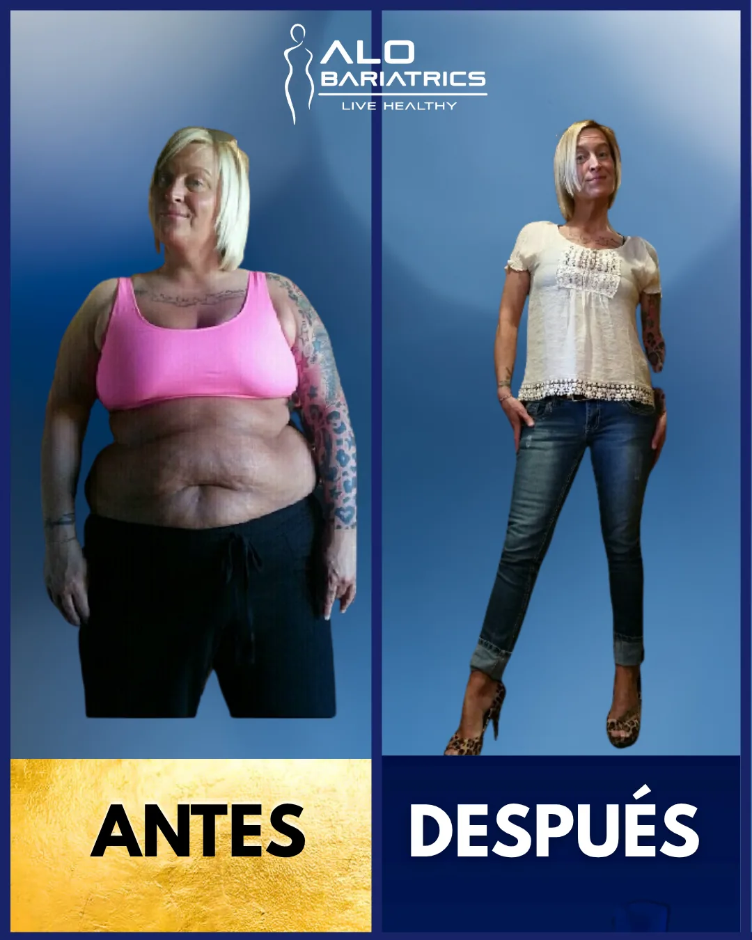 Bariatric surgery before and after — patient 49