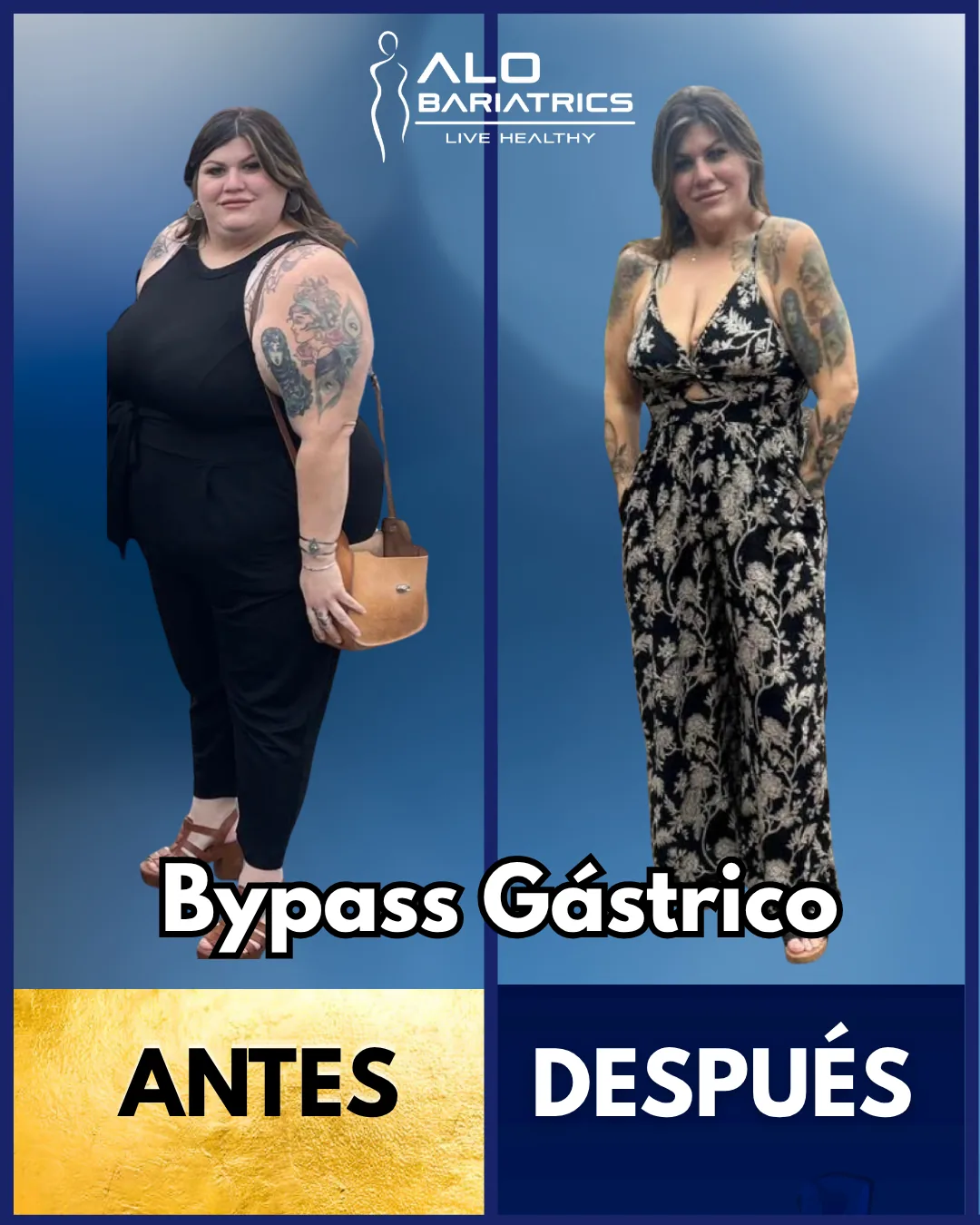 Bariatric surgery before and after — patient 5