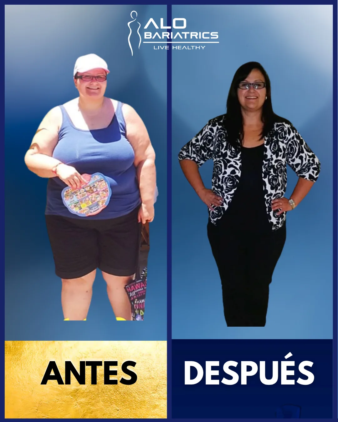 Bariatric surgery before and after — patient 50