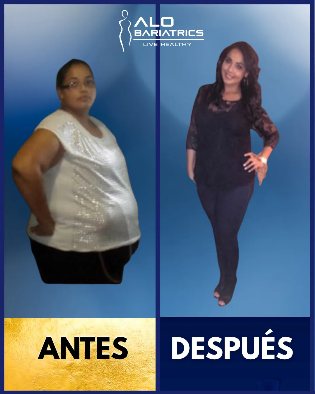 Bariatric surgery before and after — patient 51
