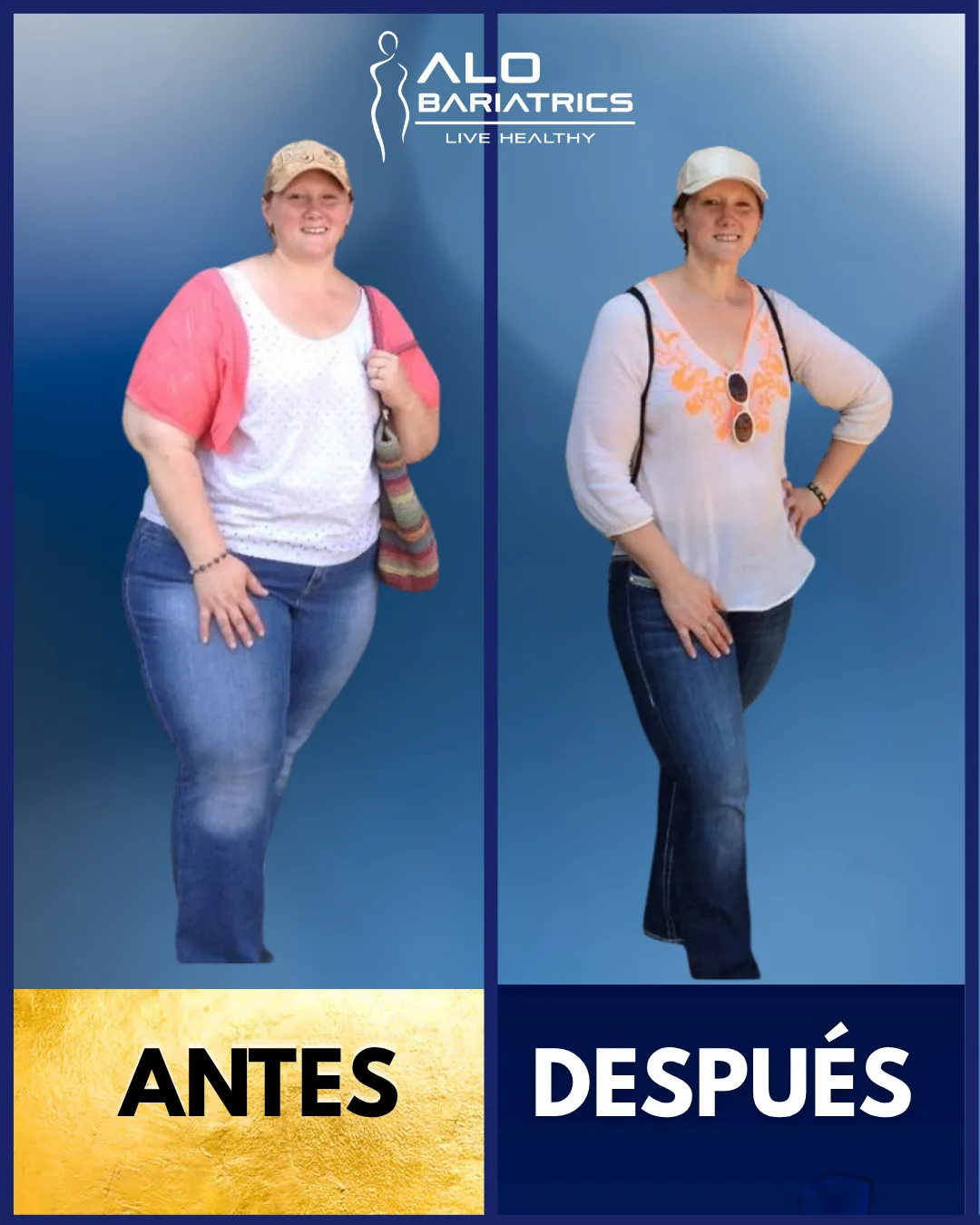Bariatric surgery before and after — patient 52