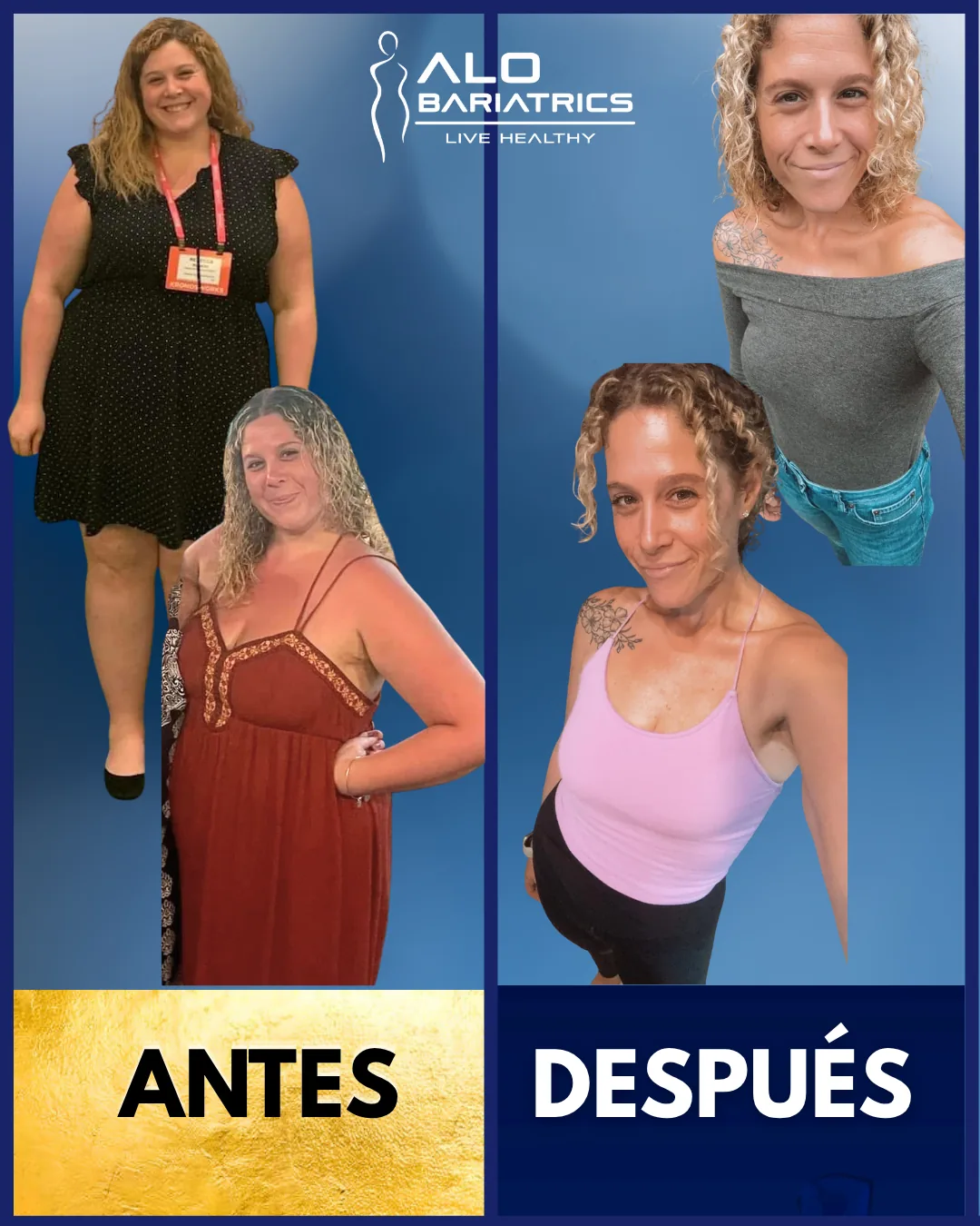 Bariatric surgery before and after — patient 53