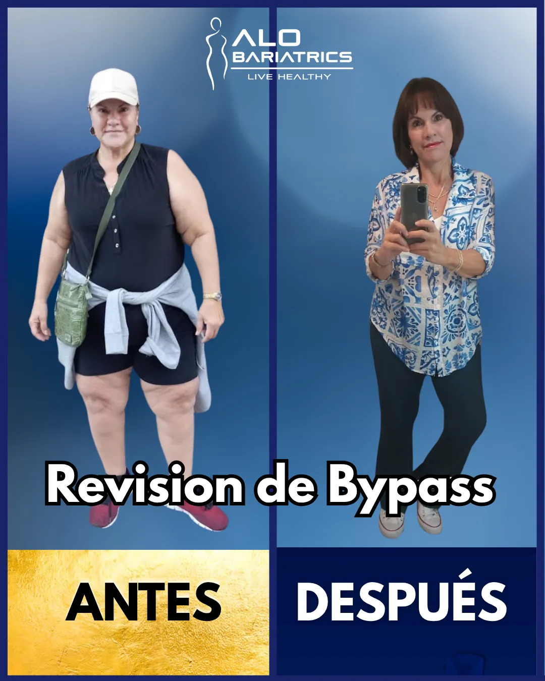 Bariatric surgery before and after — patient 54