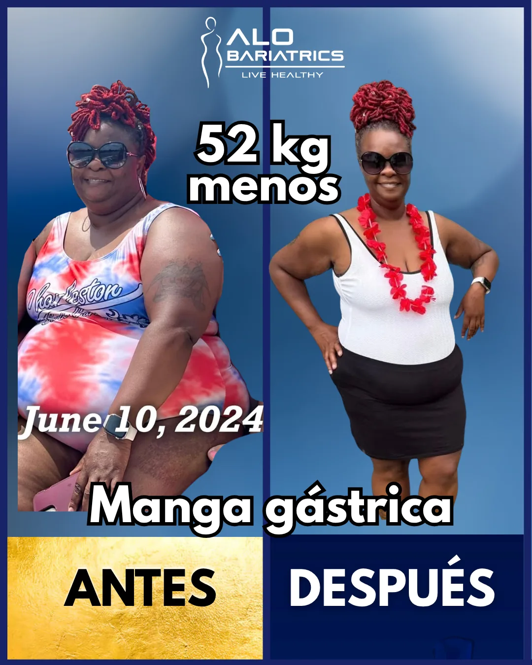 Bariatric surgery before and after — patient 55